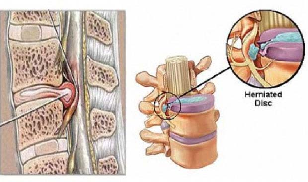 Thoát vị đĩa đệm thắt lưng